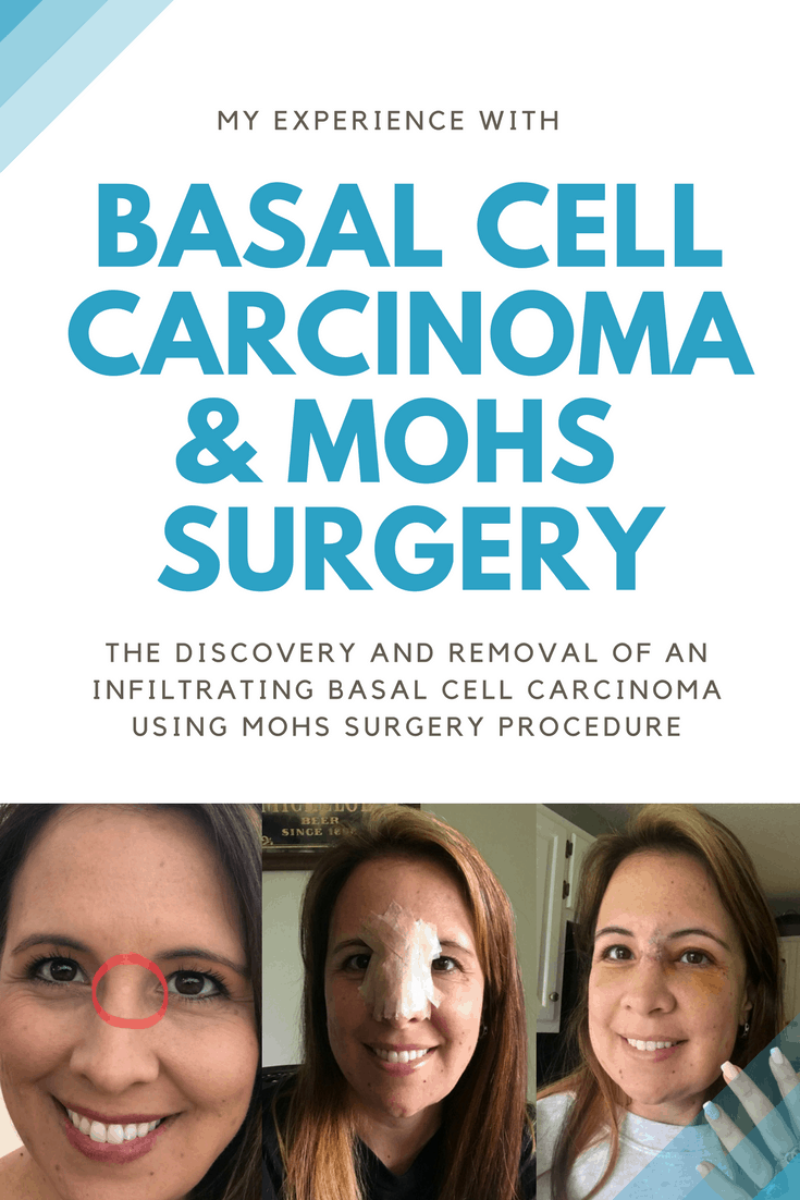 collage of pictures from basal cell carcinoma removal from face